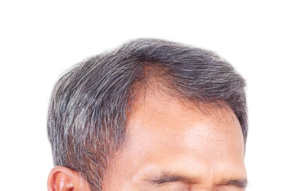 Perte de Cheveux - Alopécie Androgénique - Om Signature Clinique Médico-Esthétique